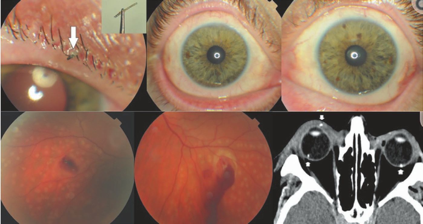 Рис. 2 Травмы глаз при взрыве шин [10] Fig. 2 Eye injuries caused by tyre explosions [10]